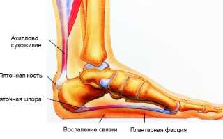 Лечение пяточной шпоры Димексидом