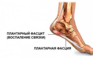 Как лечить подошвенный фасциит?