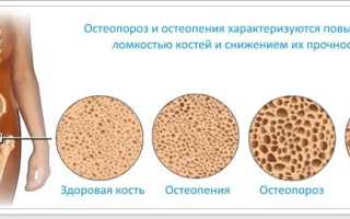 Остеопения позвоночника и шейки бедра