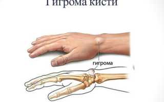 Гигрома запястья: симптомы и лечение