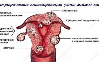 Субсерозный узел в матке