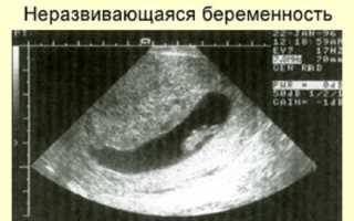 Ошибка УЗИ – замершая беременность