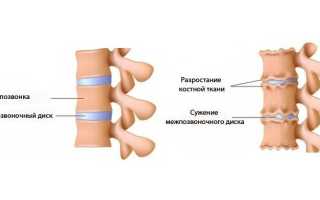 Что такое остеохондроз позвоночника?