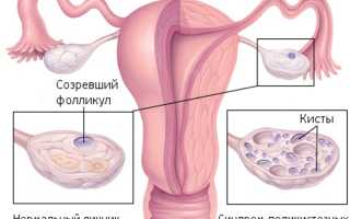 Поликистоз после родов