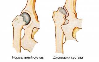 Незрелость тазобедренного сустава у новорожденных