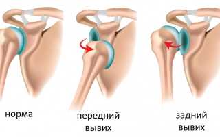 Лечение и восстановление вывиха плечевого сустава