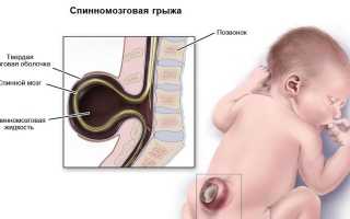 Лечение спинномозговой грыжи