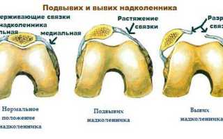 Симптомы и лечение привычного вывиха надколенника