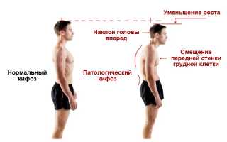 Кифоз грудного отдела позвоночника
