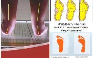Виды плоскостопия, симптомы, лечение, профилактика