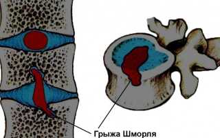 Что такое грыжа Шморля в грудном отделе позвоночника?