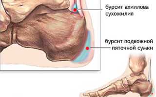 Как лечить бурсит на пятке?