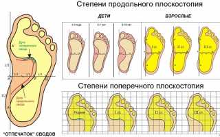 Как определить степень плоскостопия в домашних условиях?