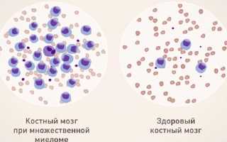 Что такое миеломная болезнь? (Симптомы, диагностика, лечение)