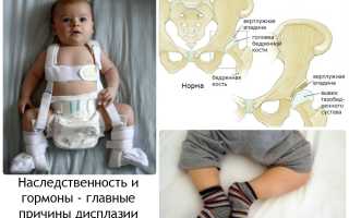 Врожденный вывих бедра и дисплазия тазобедренных суставов у новорожденных