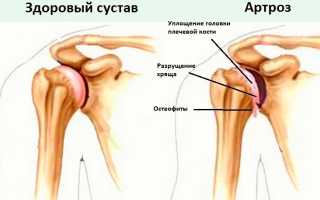 Симптомы и лечение артроза плечевого сустава