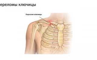 Повязка и кольца Дельбе при переломе ключицы