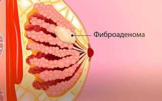 Фиброаденома молочной железы и беременность