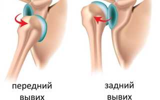 Методы вправления вывихов плеча