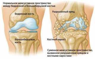 Артроз и артрит коленного сустава: симптомы и лечение