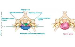 Дорзальная грыжа диска, что это такое?