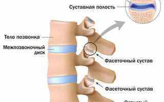 Спондилоартроз шейного отдела позвоночника: что это такое?