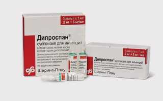 Блокада Дипроспаном сустава при артрозе