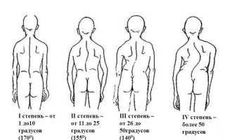 Последствия сколиоза позвоночника