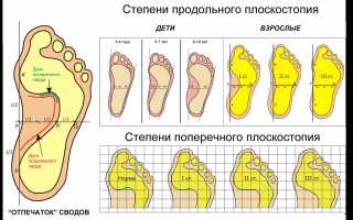 Лечение плоскостопия при разной степени тяжести