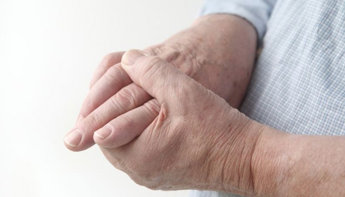 00018_health_Dr-Liu-column_arthritis