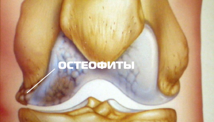 1438511750_osteofity-v-kolene