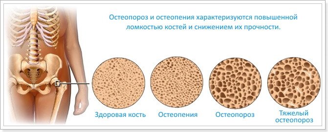 27160404-diabet-osteoporoz-i-preparaty-kalciya