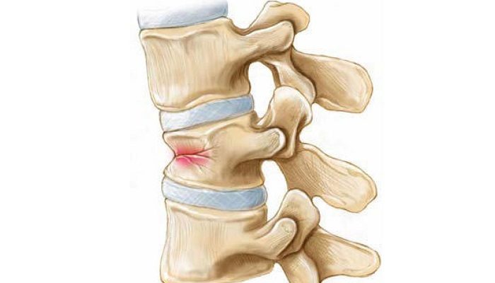 27292755-lechenie-osteohondroza-artrita-artroza