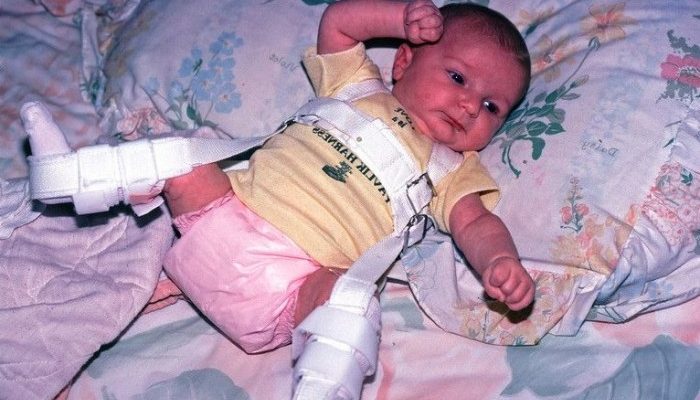 congenital_dislocation_of_the_hip_1-e1435211566213