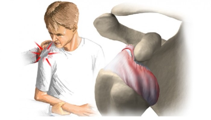 Dislocation_of_the_shoulder