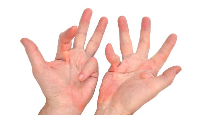 dupuytrens-contracture-hand-condition