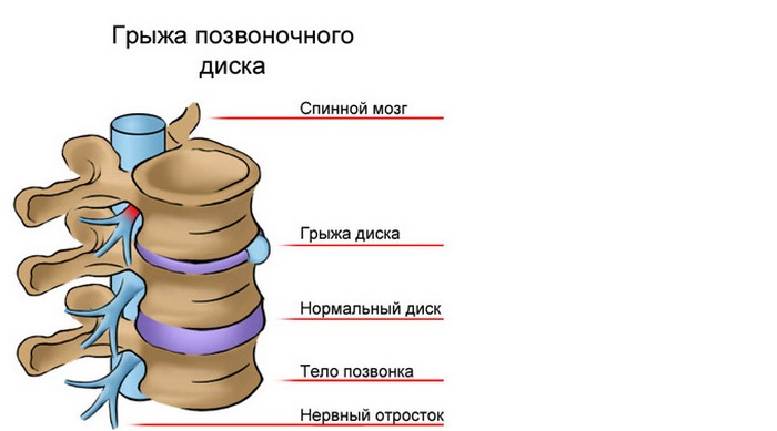 Gryzha-pozvonochnogo-diska