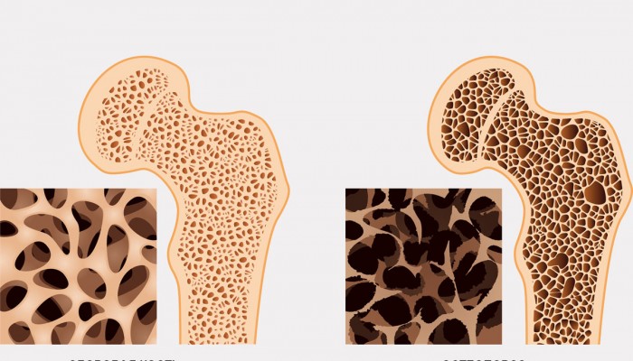 Osteoporoz