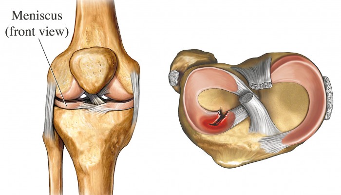 Illustration of a torn meniscus Shown are the right knee, anterior view left, and a radial tear to the anterior horn of the lateral meniscus, seen in a superior view of the tibial plateau right