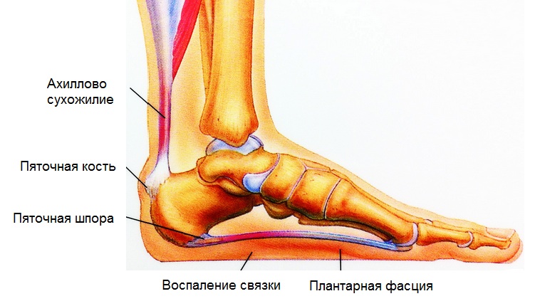 Prichiny-i-lechenie-pjatochnoj-shpory