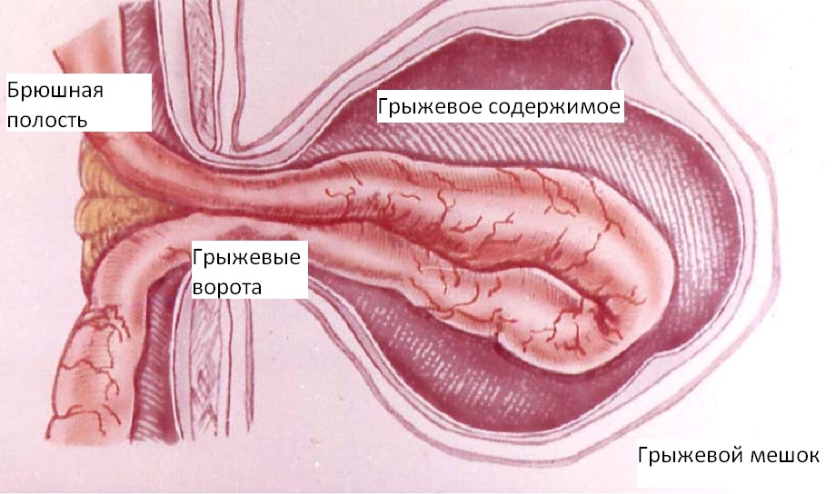 pupochnaja-gryzha1