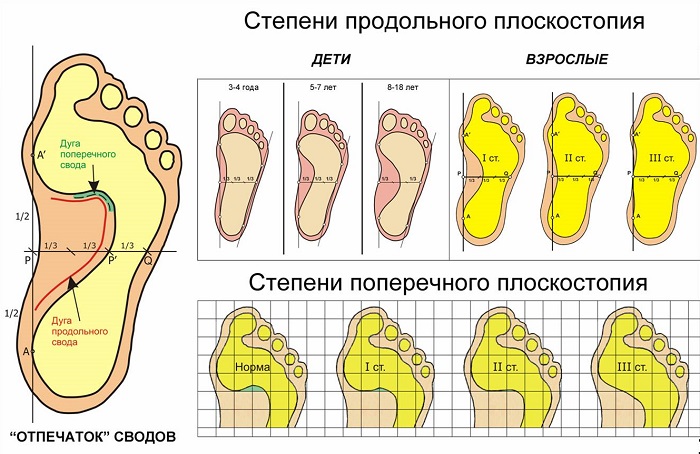 ris-2-poperechnoe-i-prodolnoe-ploskostopie