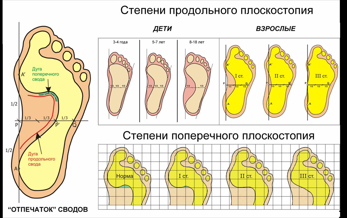 ris-2-poperechnoe-i-prodolnoe-ploskostopie