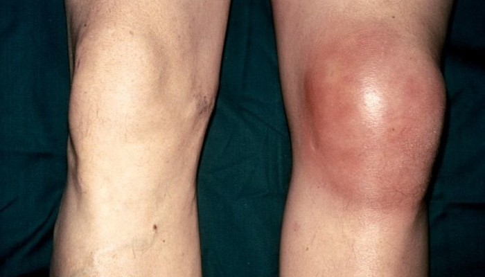 Symptoms_of_acute_bursitis_1-e1427368775992