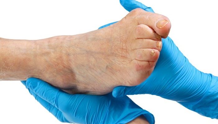 valgus_deformity_of_the_big_toe_2-e1433486985607