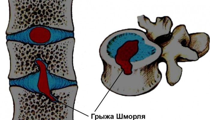 bol_pri_grige_diska_4