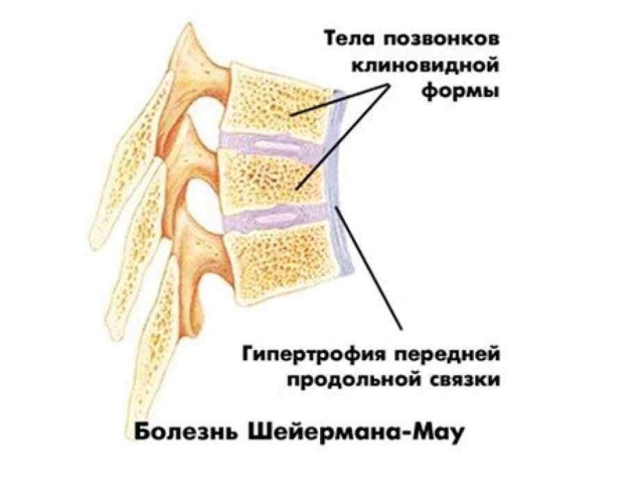 bolezn-shejermana-mau-2