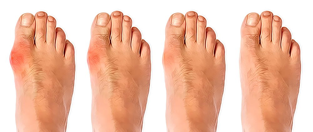 bunion mild to severe-5