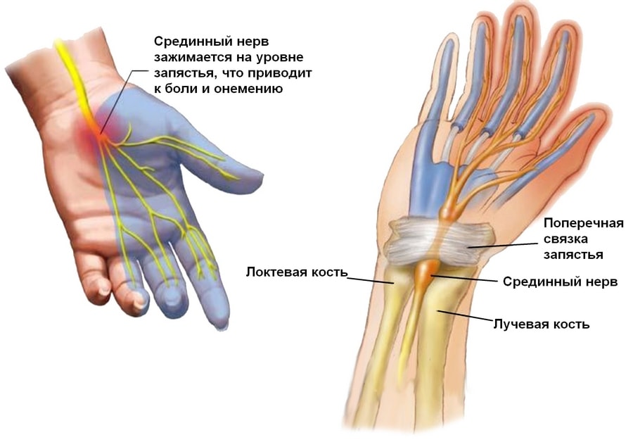 carpal-tunnel