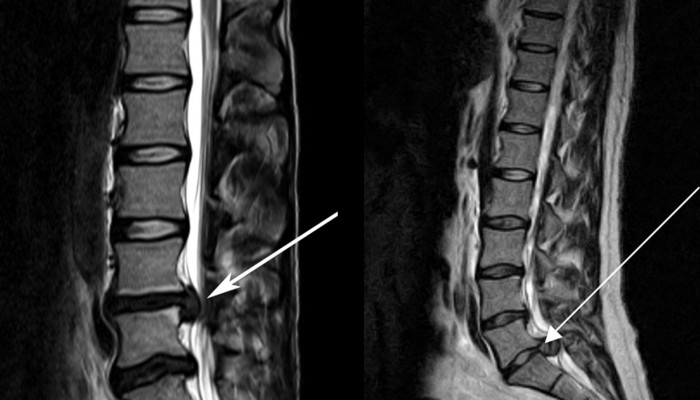 cauda-equina-spinal-MRI
